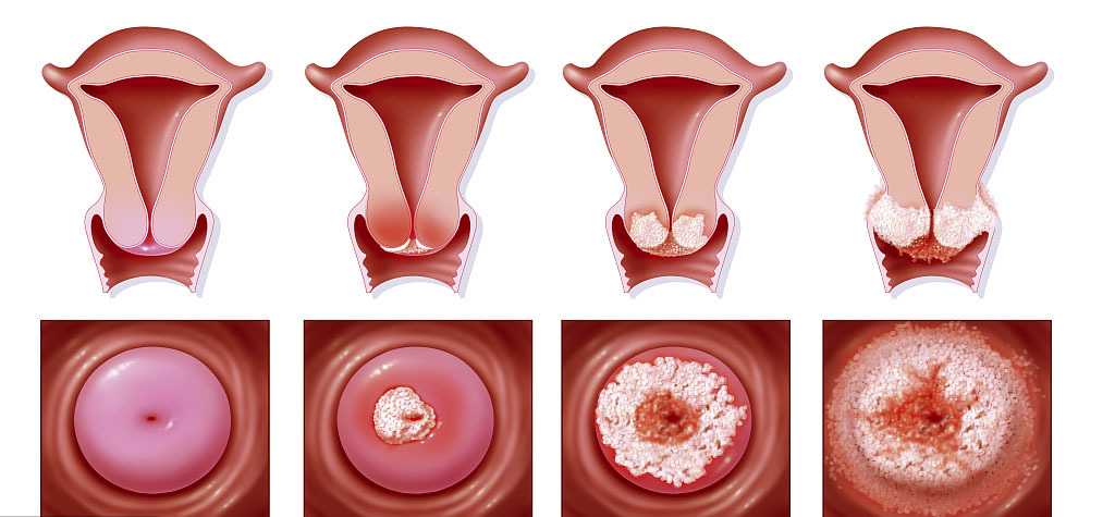 前庭大腺囊肿：症状、因及其对生活质量的影响